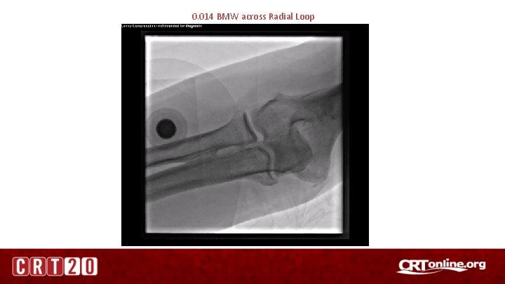 0. 014 BMW across Radial Loop 