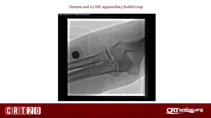 Terumo and A 2 MP approaching Radial Loop 