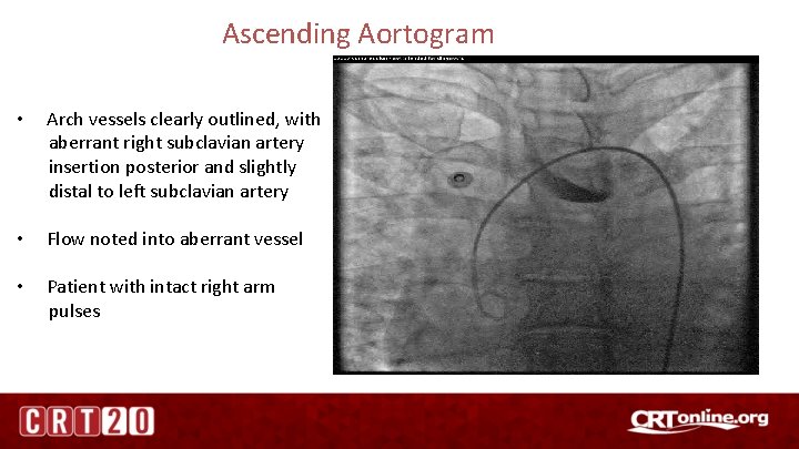 Ascending Aortogram • Arch vessels clearly outlined, with aberrant right subclavian artery insertion posterior