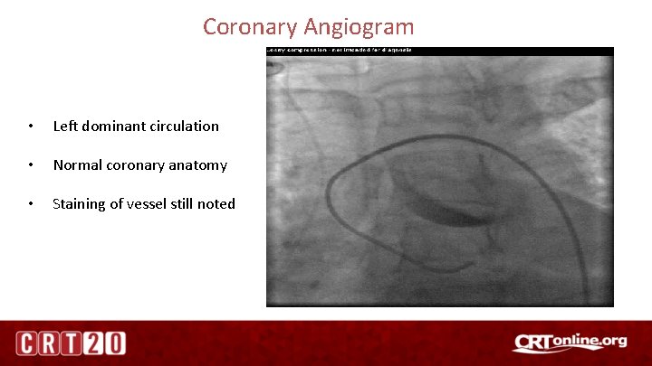 Coronary Angiogram • Left dominant circulation • Normal coronary anatomy • Staining of vessel