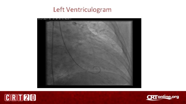 Left Ventriculogram 