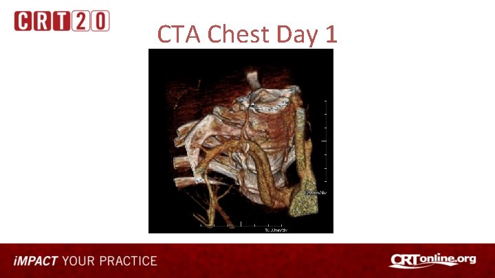 CTA Chest Day 1 