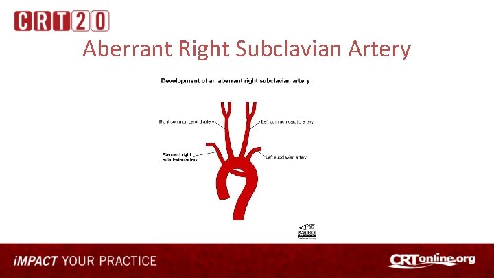 Aberrant Right Subclavian Artery 