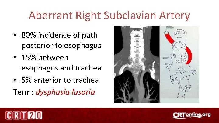 Aberrant Right Subclavian Artery • 80% incidence of path posterior to esophagus • 15%