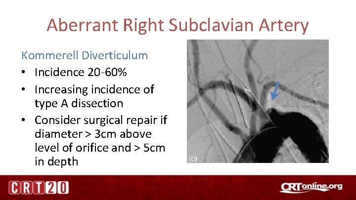 Aberrant Right Subclavian Artery Kommerell Diverticulum • Incidence 20 -60% • Increasing incidence of