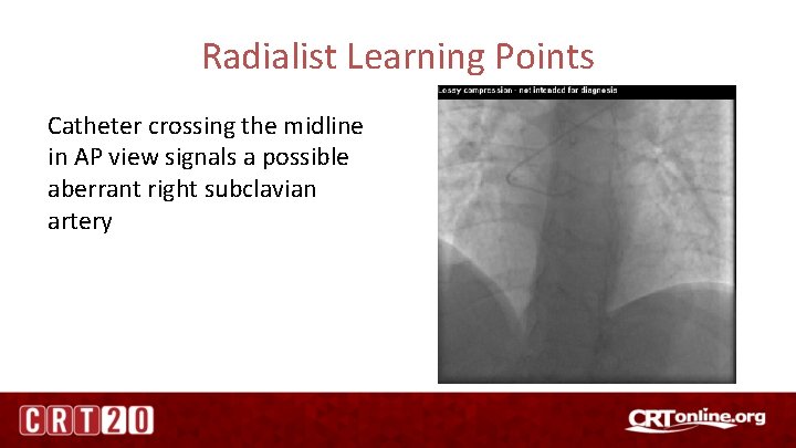 Radialist Learning Points Catheter crossing the midline in AP view signals a possible aberrant
