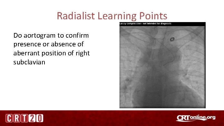 Radialist Learning Points Do aortogram to confirm presence or absence of aberrant position of