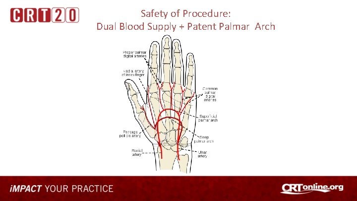 Safety of Procedure: Dual Blood Supply + Patent Palmar Arch 
