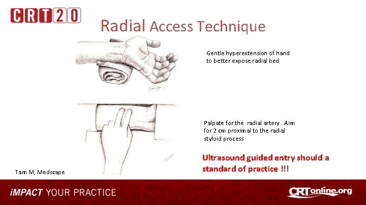 Radial Access Technique Gentle hyperextension of hand to better expose radial bed Palpate for