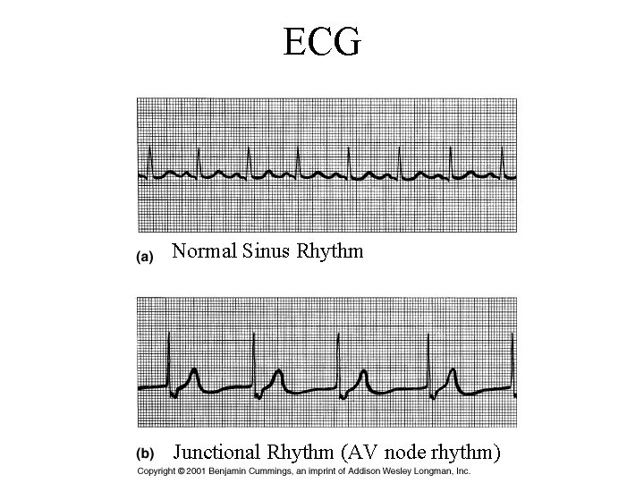 ECG Normal Sinus Rhythm Junctional Rhythm (AV node rhythm) 