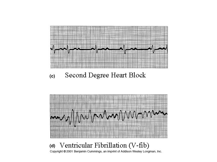 Second Degree Heart Block Ventricular Fibrillation (V-fib) 