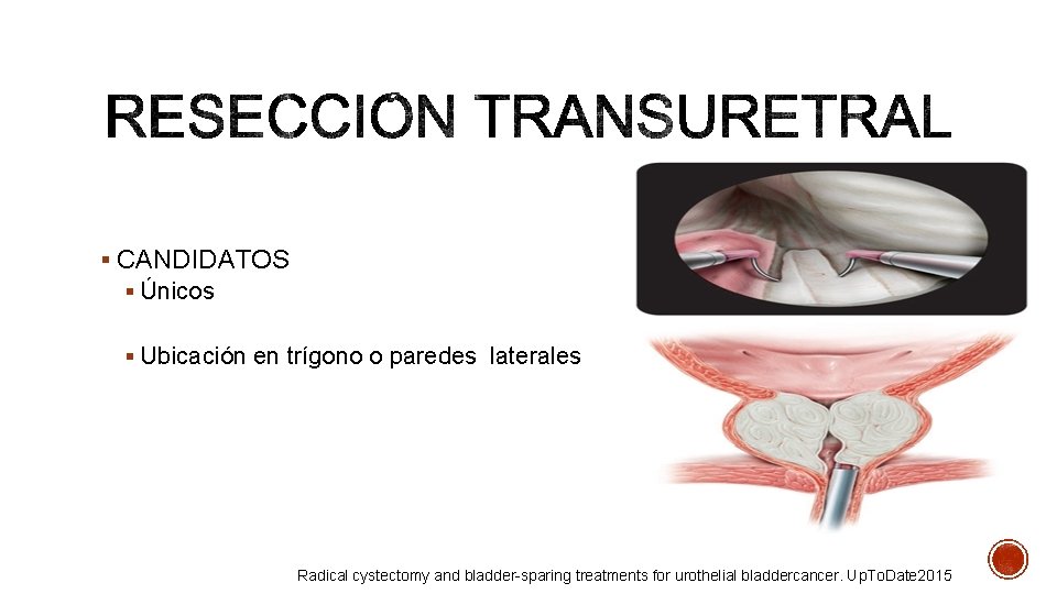 § CANDIDATOS § Únicos § Ubicación en trígono o paredes laterales Radical cystectomy and