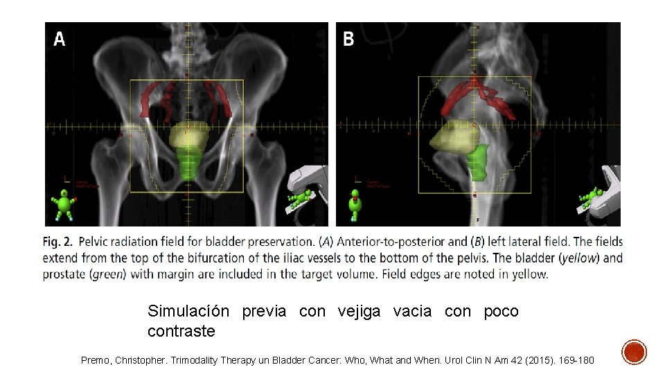 Simulacíón previa con vejiga vacia con poco contraste Premo, Christopher. Trimodality Therapy un Bladder