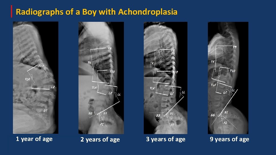 Radiographs of a Boy with Achondroplasia 1 year of age 2 years of age