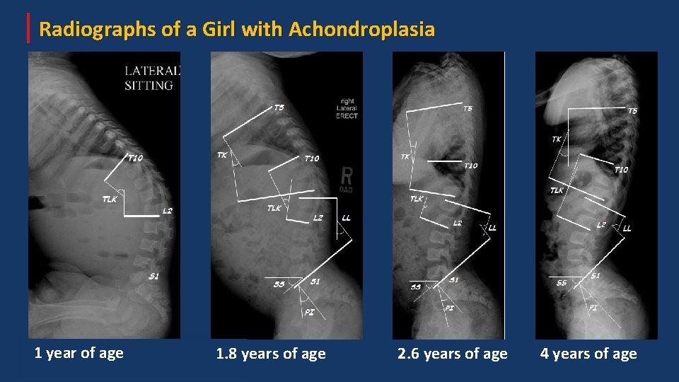 Radiographs of a Girl with Achondroplasia 1 year of age 1. 8 years of