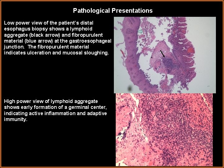 Pathological Presentations Low power view of the patient’s distal esophagus biopsy shows a lymphoid