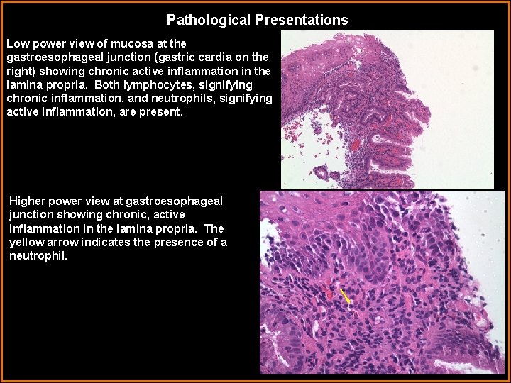 Pathological Presentations Low power view of mucosa at the gastroesophageal junction (gastric cardia on