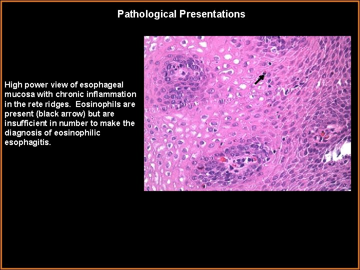 Pathological Presentations High power view of esophageal mucosa with chronic inflammation in the rete