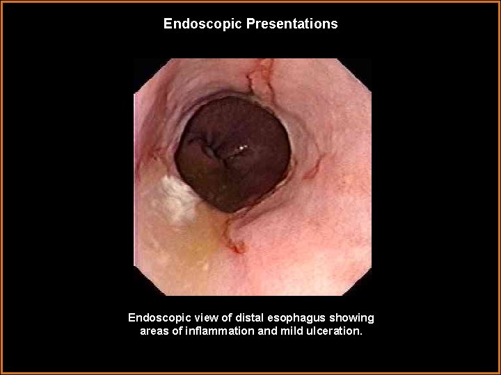 Endoscopic Presentations Endoscopic view of distal esophagus showing areas of inflammation and mild ulceration.