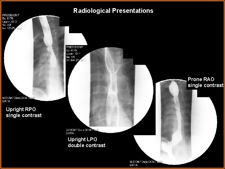 Radiological Presentations Prone RAO single contrast Upright RPO single contrast Upright LPO double contrast