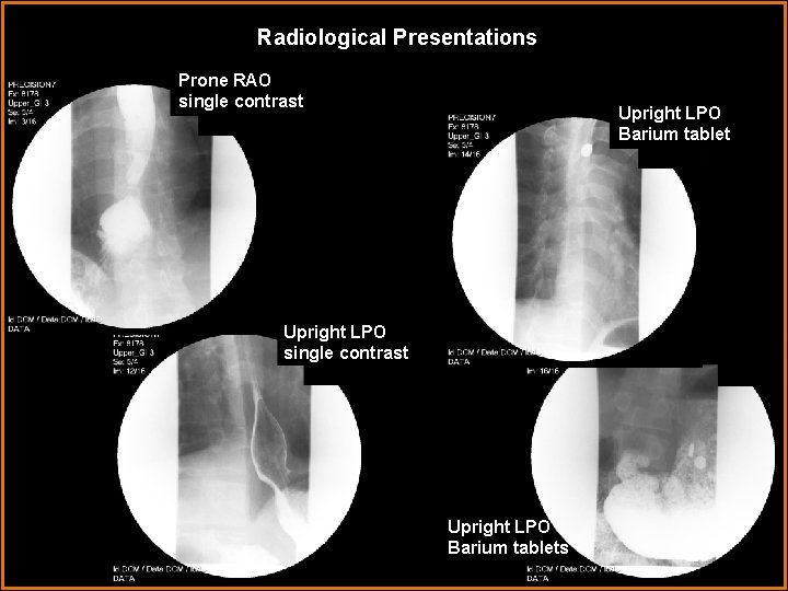 Radiological Presentations Prone RAO single contrast Upright LPO Barium tablet Upright LPO single contrast