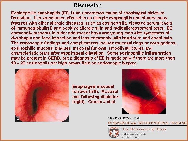 Discussion Eosinophilic esophagitis (EE) is an uncommon cause of esophageal stricture formation. It is