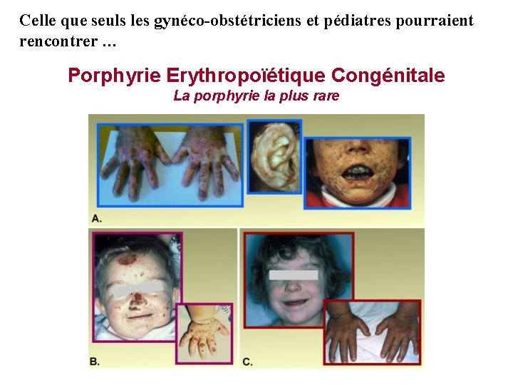 Celle que seuls les gynéco-obstétriciens et pédiatres pourraient rencontrer … Porphyrie Erythropoïétique Congénitale La