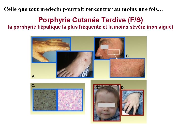 Celle que tout médecin pourrait rencontrer au moins une fois… Porphyrie Cutanée Tardive (F/S)