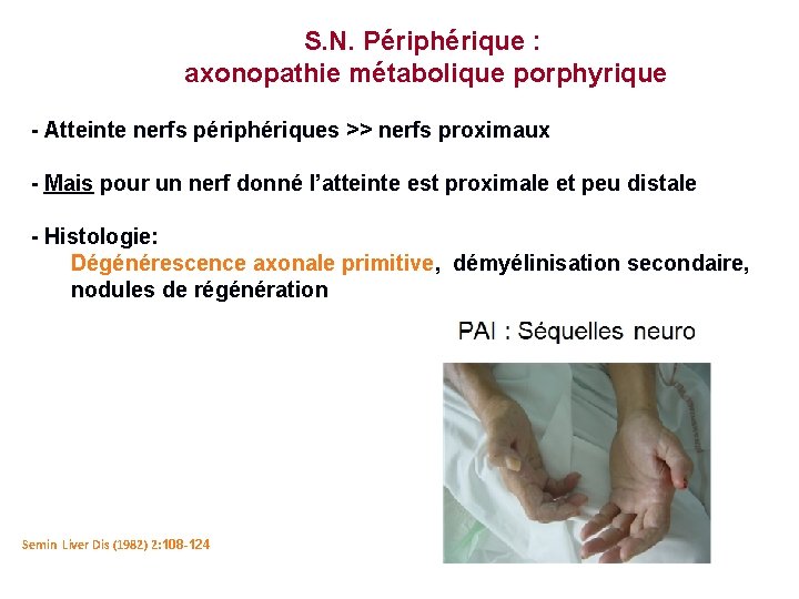 S. N. Périphérique : axonopathie métabolique porphyrique - Atteinte nerfs périphériques >> nerfs proximaux