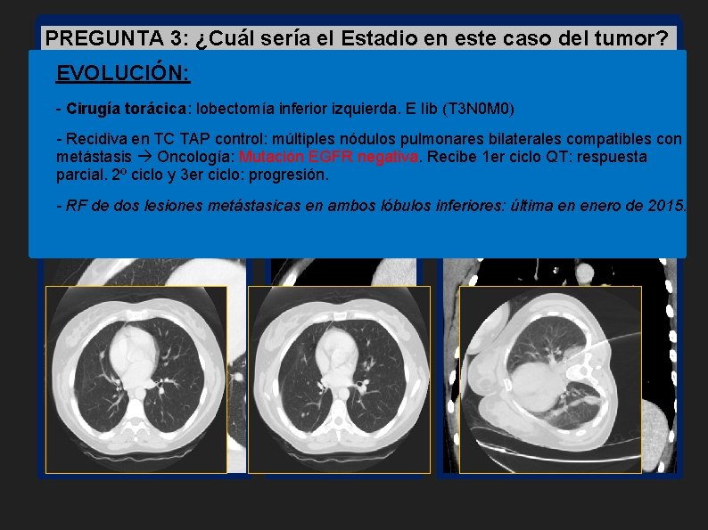  • PREGUNTA Resumen TC TAP: sería el Estadio en este caso del tumor?