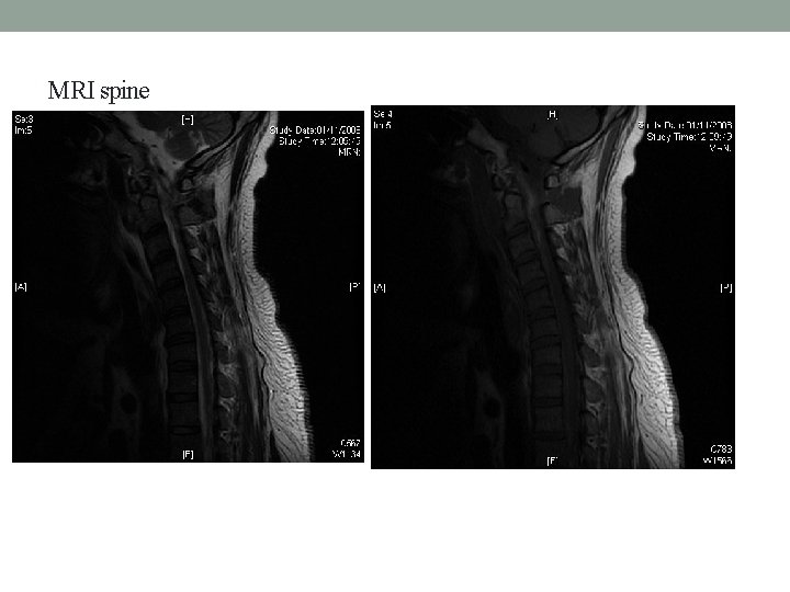 MRI spine 