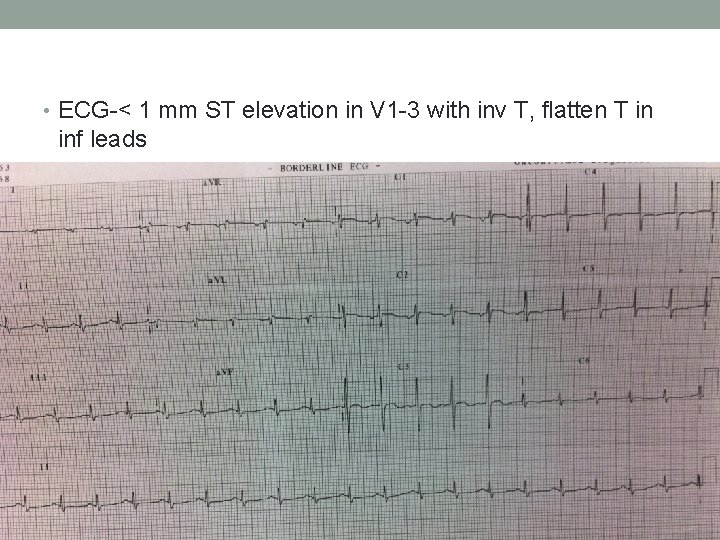  • ECG-< 1 mm ST elevation in V 1 -3 with inv T,
