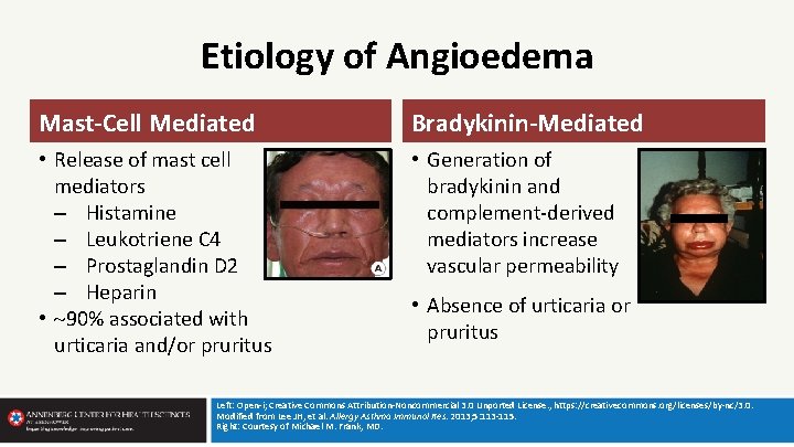 Etiology of Angioedema Mast-Cell Mediated Bradykinin-Mediated • Release of mast cell mediators – Histamine