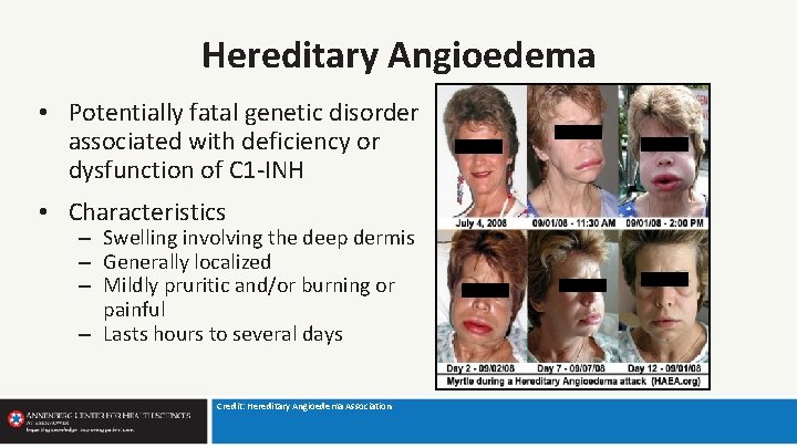 Hereditary Angioedema • Potentially fatal genetic disorder associated with deficiency or dysfunction of C