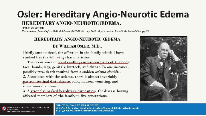 Osler: Hereditary Angio-Neurotic Edema Osler W. Am J Med Sci. 1888; 95: 362 -367.