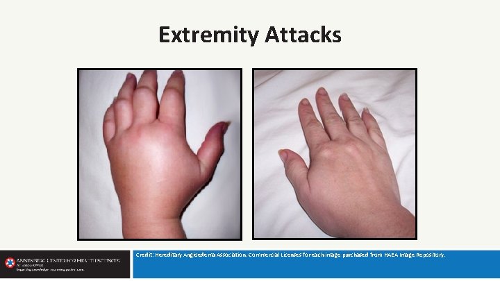 Extremity Attacks Credit: Hereditary Angioedema Association. Commercial Licenses for each image purchased from HAEA