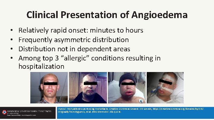 Clinical Presentation of Angioedema • • Relatively rapid onset: minutes to hours Frequently asymmetric