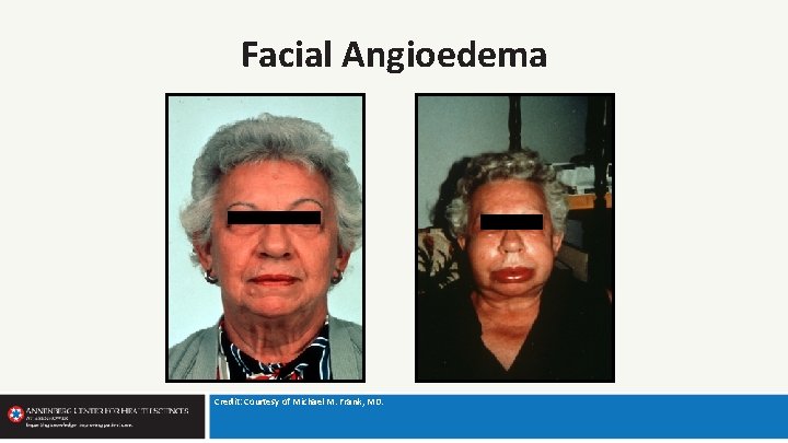 Facial Angioedema Credit: Courtesy of Michael M. Frank, MD. 