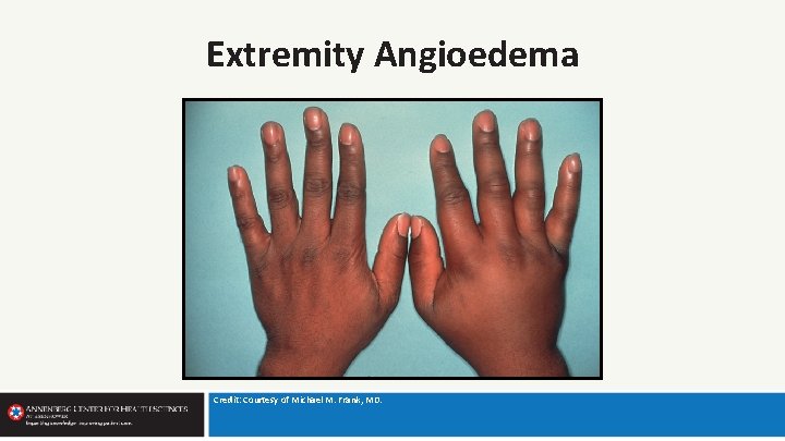 Extremity Angioedema Credit: Courtesy of Michael M. Frank, MD. 