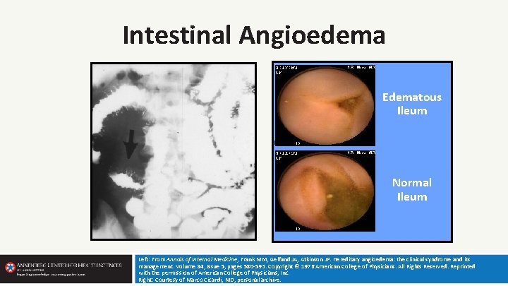 Intestinal Angioedema Edematous Ileum Normal Ileum Left: From Annals of Internal Medicine, Frank MM,