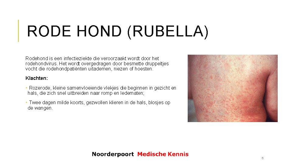 RODE HOND (RUBELLA) Rodehond is een infectieziekte die veroorzaakt wordt door het rodehondvirus. Het