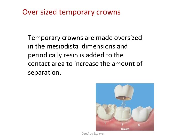Over sized temporary crowns Temporary crowns are made oversized in the mesiodistal dimensions and
