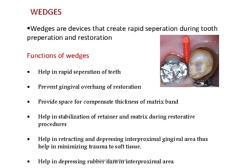WEDGES §Wedges are devices that create rapid seperation during tooth preperation and restoration Functions
