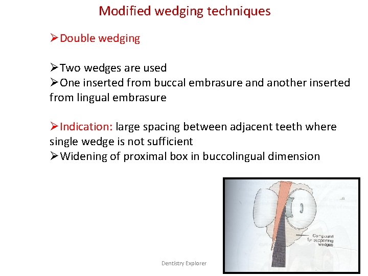 Modified wedging techniques ØDouble wedging ØTwo wedges are used ØOne inserted from buccal embrasure