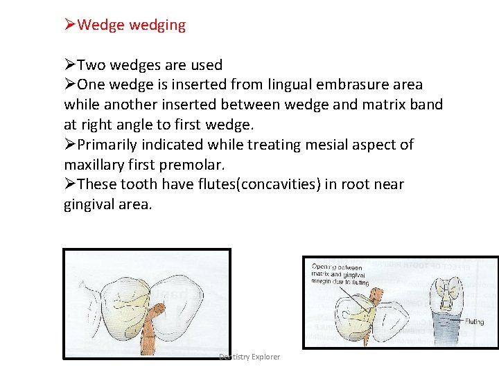 ØWedge wedging ØTwo wedges are used ØOne wedge is inserted from lingual embrasure area