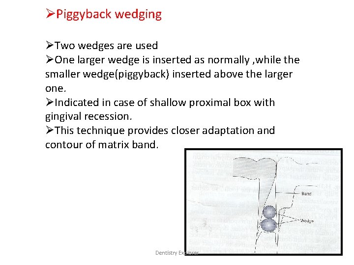 ØPiggyback wedging ØTwo wedges are used ØOne larger wedge is inserted as normally ,