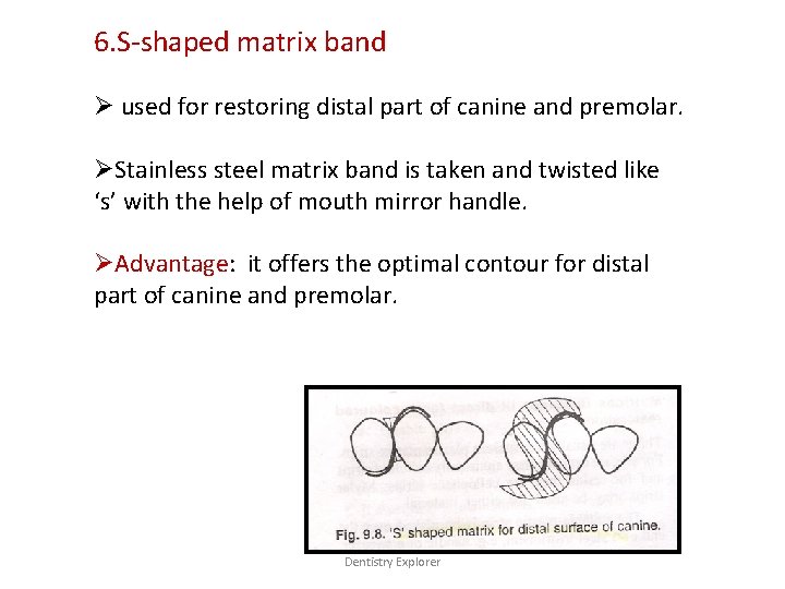 6. S-shaped matrix band Ø used for restoring distal part of canine and premolar.