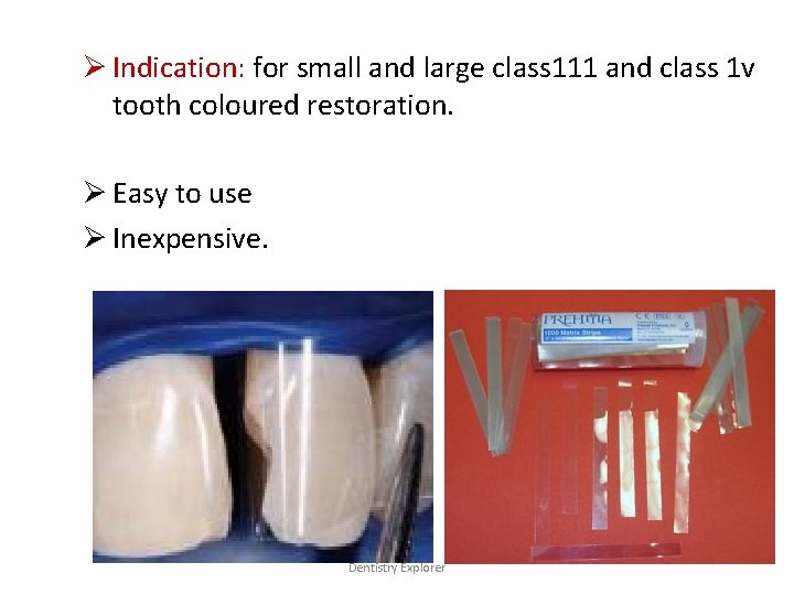 Ø Indication: for small and large class 111 and class 1 v tooth coloured