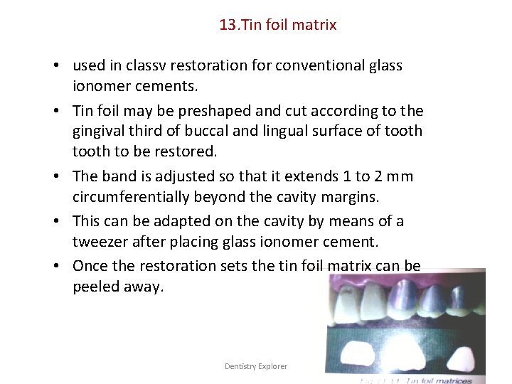 13. Tin foil matrix • used in classv restoration for conventional glass ionomer cements.
