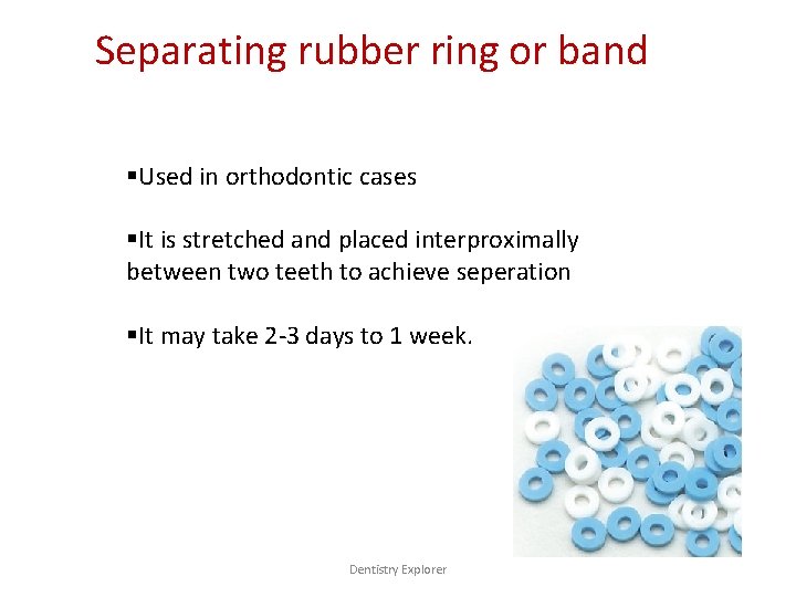 Separating rubber ring or band §Used in orthodontic cases §It is stretched and placed